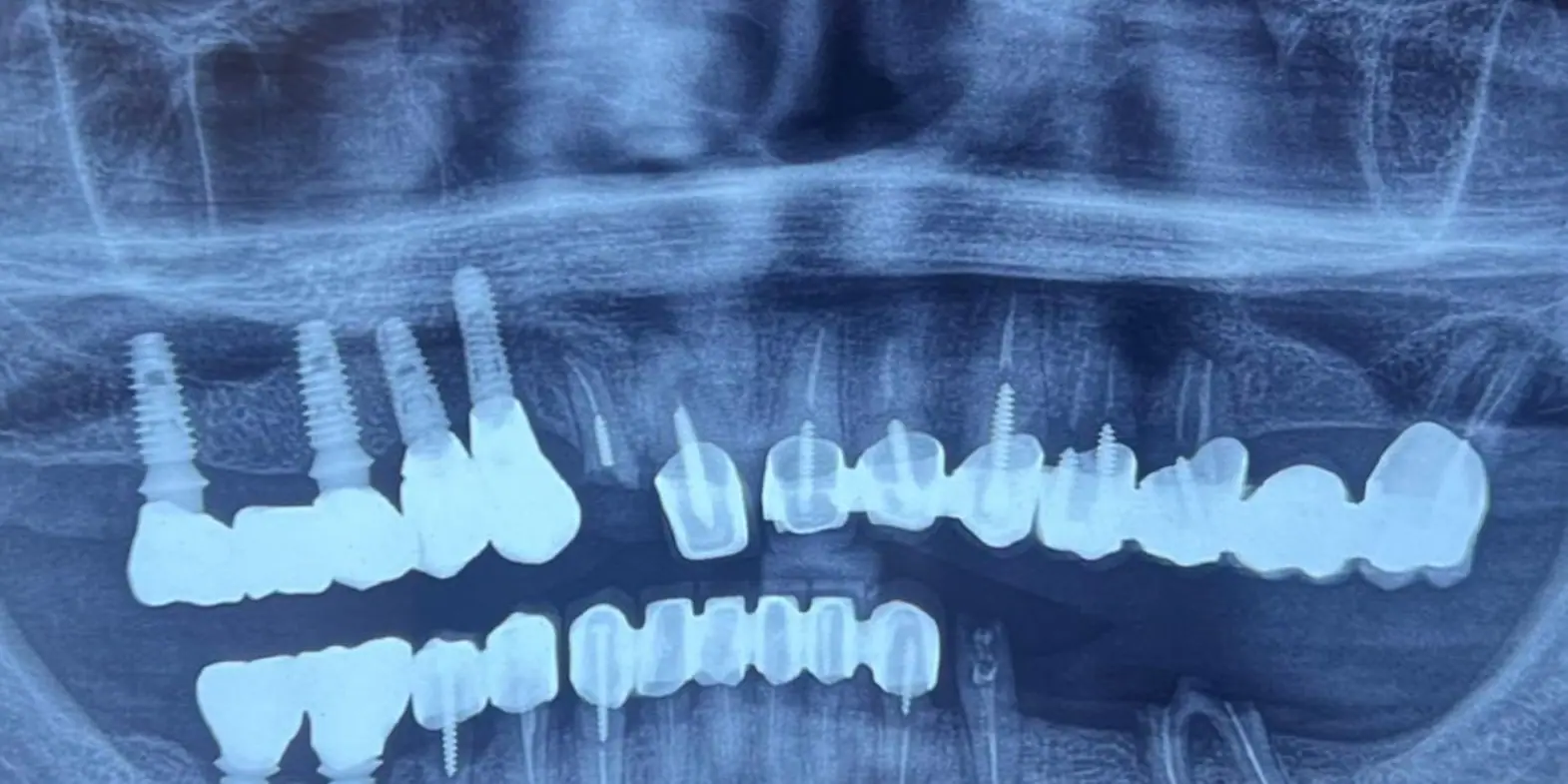 Para: Radiografia panoramike, para dhe pas